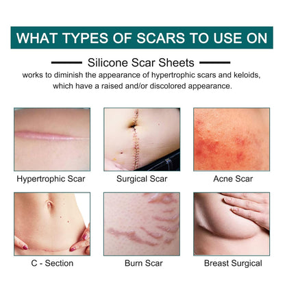 Silicone Scar Sheets