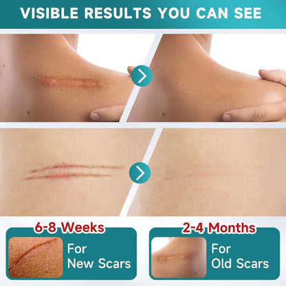 Silicone Scar Sheets